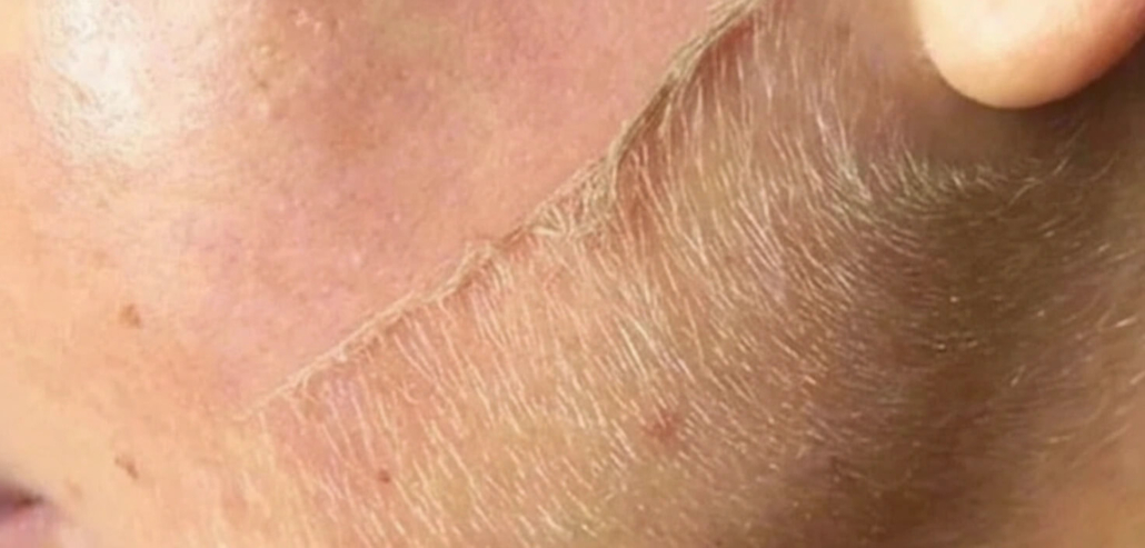 Dermaplaning-Services