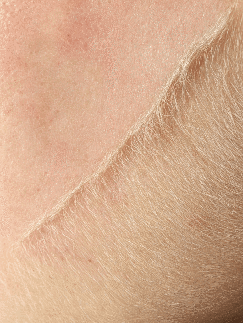dermaplaning-treatment