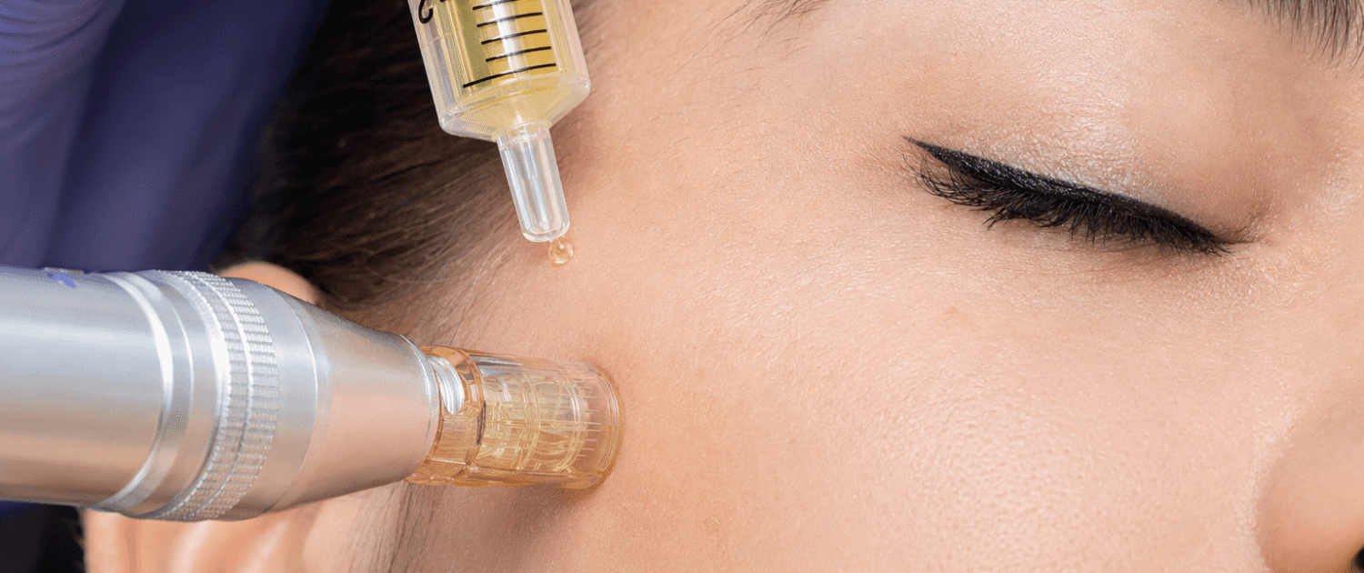 skin-needling-treatment